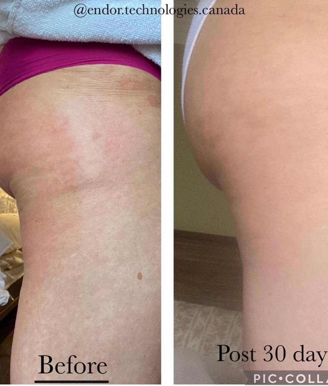 Нано-крем проти целюліту Технології Celltense Anti Cellulite Cream, Endor